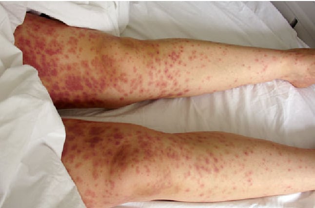 Fiebre maculosa de las Montañas Rocosas